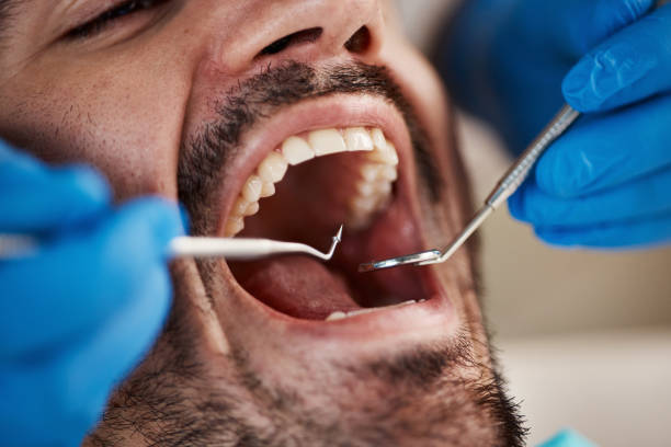 Best Emergency Tooth Extraction in Lafayette, CA