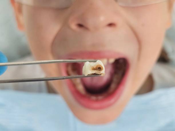 Best Emergency Treatment for Dental Infections or Abscesses in Lafayette, CA